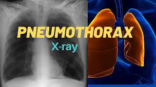 How to identify Pneumothorax in Chest Xray