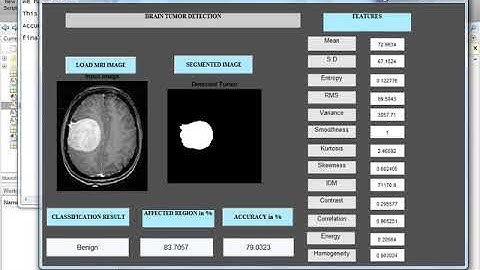 BRAIN TUMOR Detection Using Image Processing In Matlab-1Crore Projects