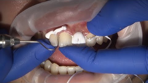 Chairside Live Episode 259: How to Maximize Results in the Esthetic Zone