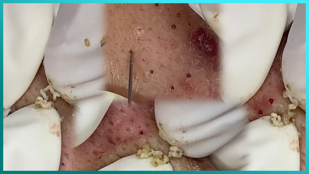 Tons of blackheads on the back. Acne extractions. Blackheads and whiteheads. Mining pore dirt.