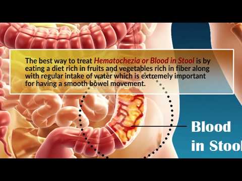 3 Effective Natural Remedies For Blood In Stool Or Hematochezia