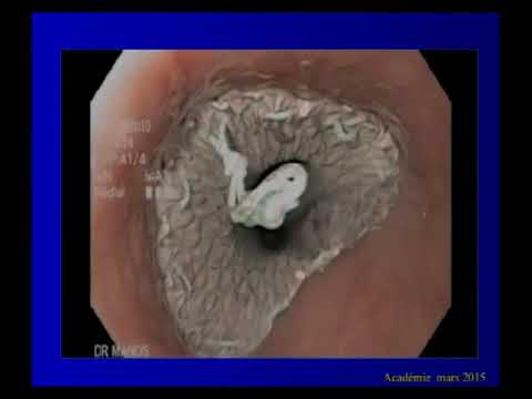 Vidéo: Fistule Gastrique - Causes, Symptômes, Complications Et Traitement De La Fistule Gastrique