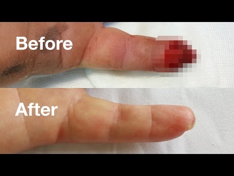 ameliorați inflamația articulară a degetului mare grunman dedeman