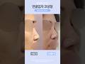 바로코 연골입자 코성형 전/후#자가연골코성형 #무보형물코성형 #코성형잘하는곳 #강남코성형