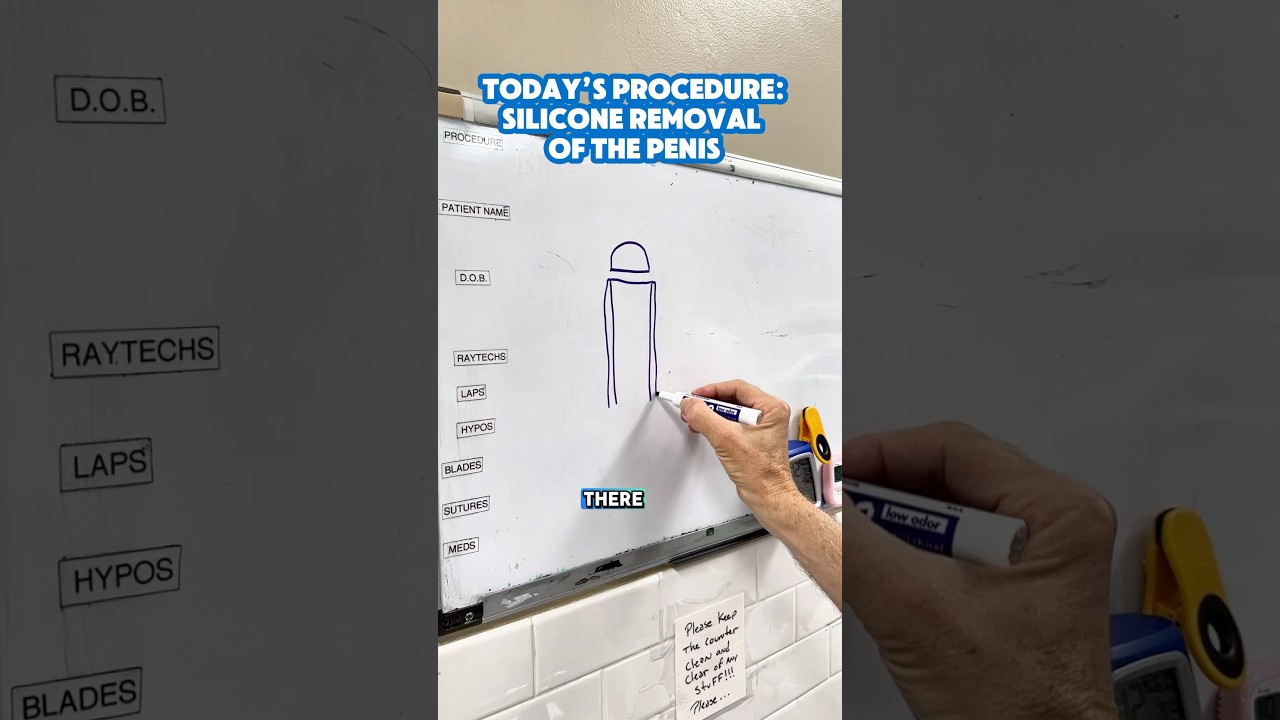 How Dr. Katzen removes silicone from the penis