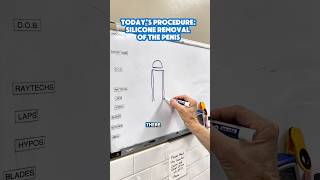 How Dr Katzen Removes Silicone From The Penis