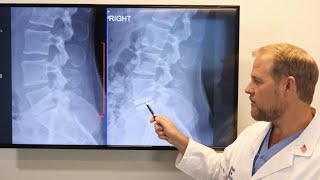 Lumbar Disc Replacement Surgery Explained By a Spine Surgeon