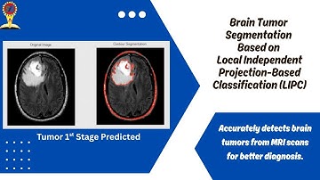 Brain Tumor #Segmentation Using Local Independent Projection Based Classification-LIPC #cancerstages