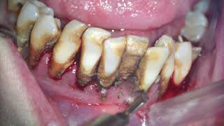 Scaling and root planing - huge dental calculus