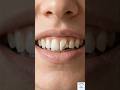 Chipped/broken front tooth restoration/Composite Filling #dental #dentalcare #dentaltips#Tooth#teeth
