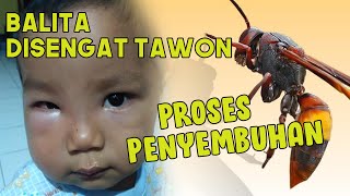 Download Lagu PROSES PENYEMBUHAN ANAK KECIL DISENGAT TAWON | pengobatan sengatan tawon MP3
