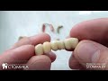 Разновидности зубных протезов (коронки, мосты и т.д.)