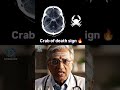 Crab of Death Sign | Best app for NEET PG Preparation |Dopamine|