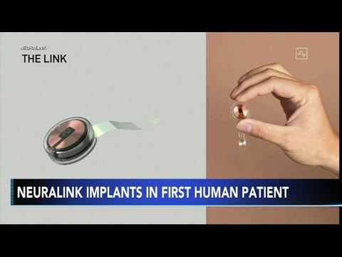 Neuralink implants brain chip in 1st human patient