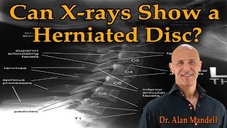 Can X-rays Show a Herniated Disc? - Dr. Alan Mandell, D.C.