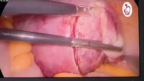 Laparoscopic myomectomy of 7-8cm fibroid  by Bipolar shearer after vasopressin 