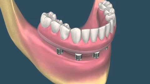 Prótese inferior fixa sobre implantes: Protocolo Inferior