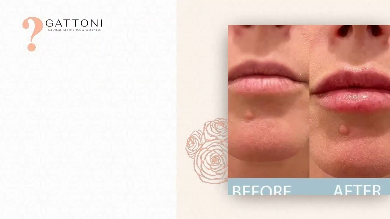 GATTONI Medical Aesthetics & Wellness: Where To Get The Best Lip Filler In Denver?