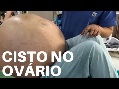 Vídeo: Os cistos ovarianos podem ser cancerígenos?