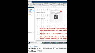 Fetal Brain Abnormalities Detection using KNN CODE MATLAB CODE-FETAL BRAIN Fetal Brain Abnormalities