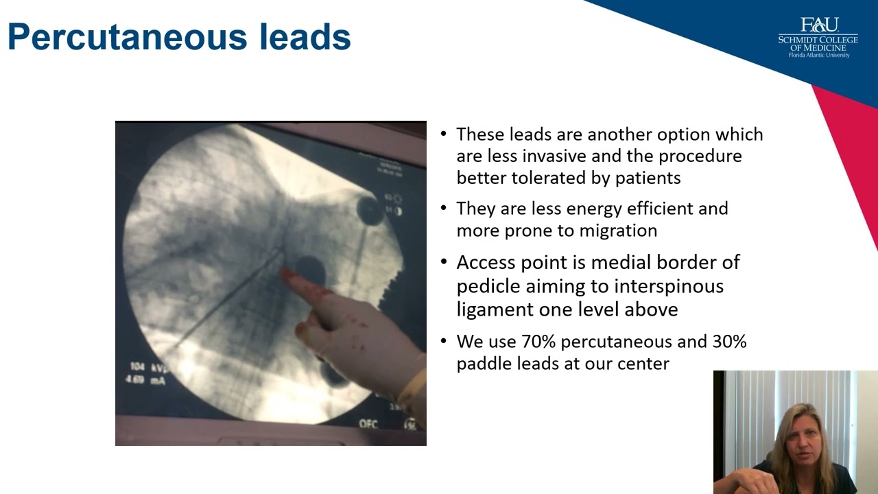 CNS Neurosurgery 100: Spinal Cord and Peripheral Nerve Stimulation
