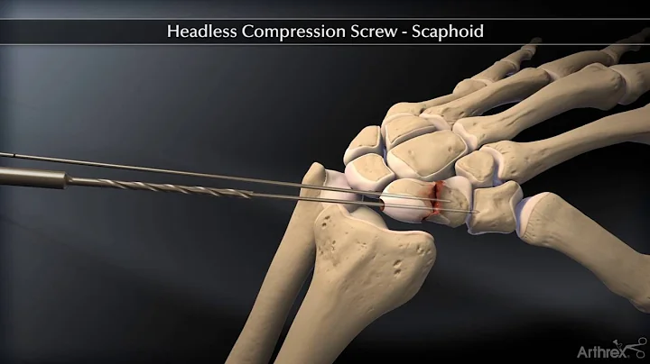 Headless Compression Screw – Scaphoid