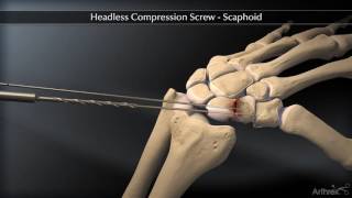 Headless Compression Screw – Scaphoid