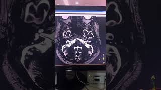 DRIVE AXIAL (IAC)/CISS MRI BRAIN IMAGING #anatomy