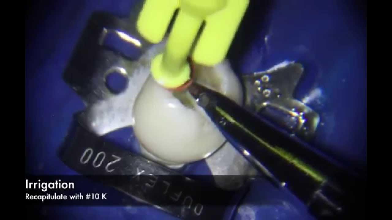 Manual Technique for Curved Root Canal Preparation YouTube