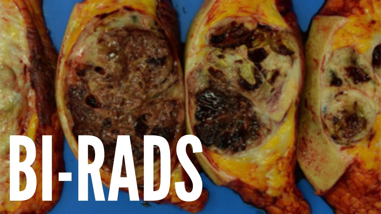 O que significa BIRADS na mamografia?