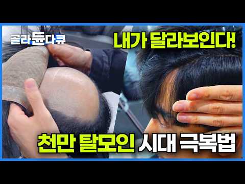 <strong>티가</strong> 안날 수록 좋다! 천만 탈모인 시대 가지각색 고민 극복법 ┃ 가늘어지거나 빠지거나! 대부분은 유전인 탈모 ┃탈모 이식 방법┃탈모 고민 해결사┃극한직업┃#골라듄다큐