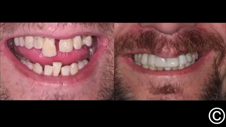 Save Loose Teeth - Brad Mello