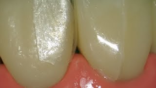Bioclear Black Triangle (hands on)