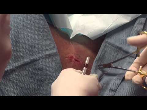 A Standard Cyst Excision On The Back. For Medical Education- NSFE.