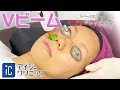 Vビーム 施術動画 アイシークリニック