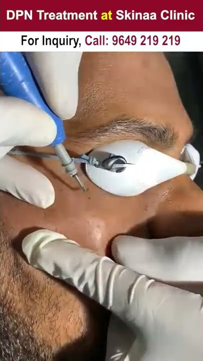 DPN Treatment at Skinaa Clinic #DPN #dpntreatment #shorts  #viral  #skinaa_clinic #skinaaclinic