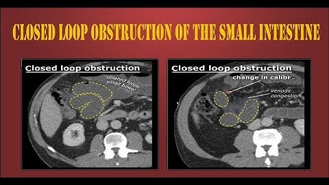 Closed loop obstruction of the small intestine