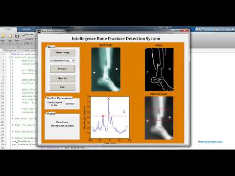 Bone Fracture Detection MATLAB code | MATLAB project