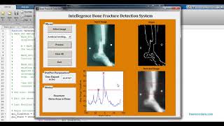 Bone Fracture Detection MATLAB code | MATLAB project