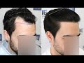 FUE Hair Transplant (1531 Grafts NW III A) By Dr Juan Couto - FUEXPERT CLINIC, Madrid, Spain