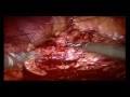 Robotic Partial nephrectomy by Dr Sanjai Addla, Robotic Urooncologist, Hyderabad