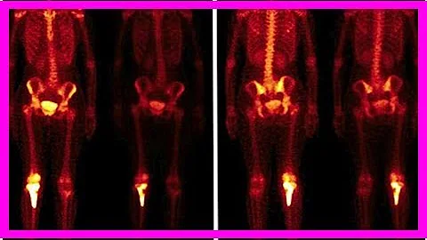 Was anziehen Bei Knochenszintigraphie?