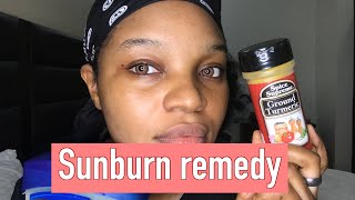 How to get rid of sunburn fast on the face /Natural home remedy for sunburns