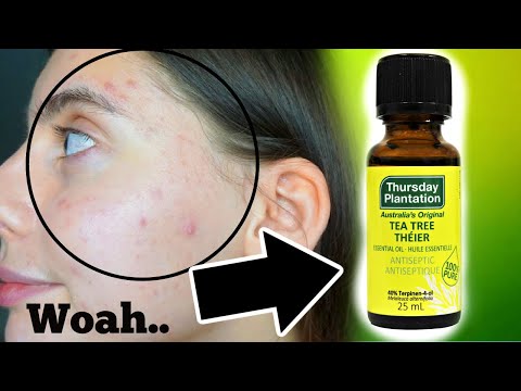 I TESTED TEA TREE OIL ON MY PIMPLES FOR ONE WEEK || DOES THIS WORK!!?!?