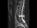 Pars defects of the lumbar spine
