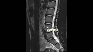 Pars defects of the lumbar spine