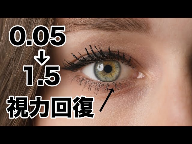 視力0 05から1 5へ回復 レーシック Icl手術３年目のレビュー Youtube