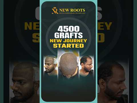 4500 Grafts Hair Transplant in Pune | Cost & Best Results #hairtransplant #pune #shorts