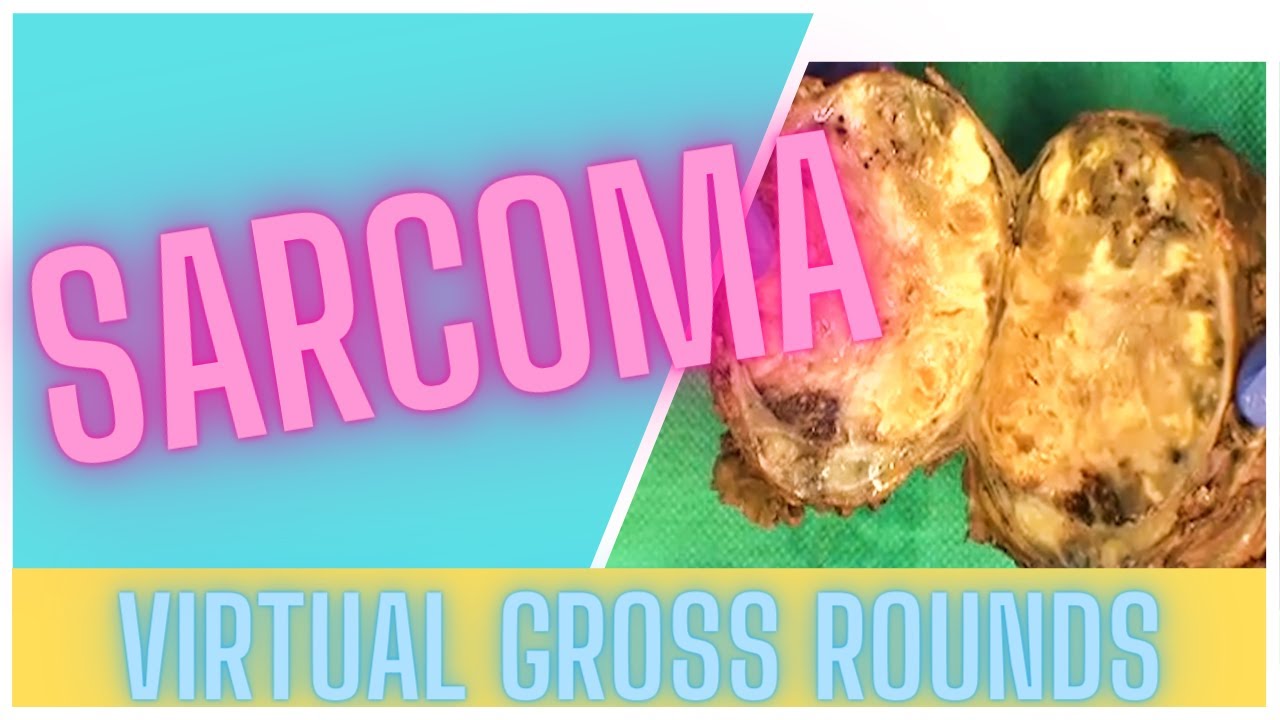 VGR - Grossing a Soft tissue sarcoma (of the extremity) specimen