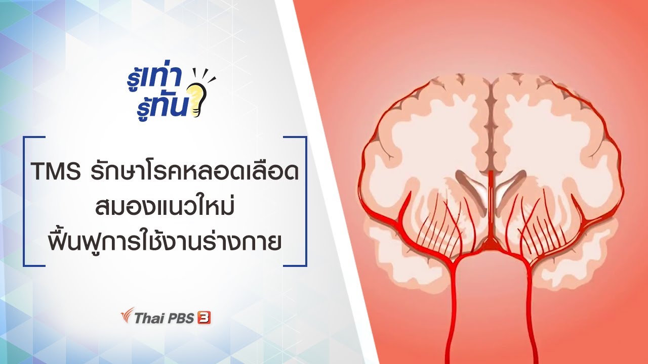TMS รักษาโรคหลอดเลือดสมองแนวใหม่ ฟื้นฟูการใช้งานร่างกาย : รู้เท่ารู้ทัน (18 ก.ย. 63)